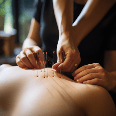 A Photo Of An Acupuncture Treatment In Progress. A Woman Is Lying On A Table, And A Practitioner Is Inserting Thin Needles Into Her Body.